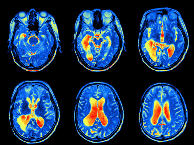 Car Accidents Can Result in Mild or Severe Traumatic Brain Injury