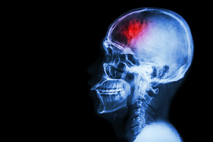 Louisville Brain Injury Attorneys